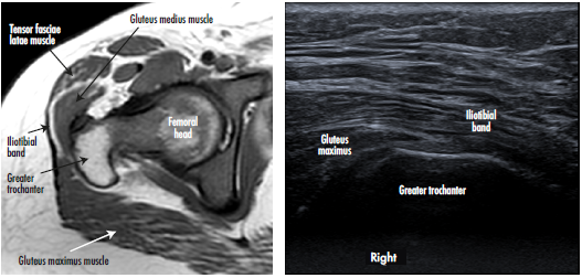 Magnetic Resonance And Ultrasound Cross Sectional Plane Of The Right Hip Of An Asymptomatic