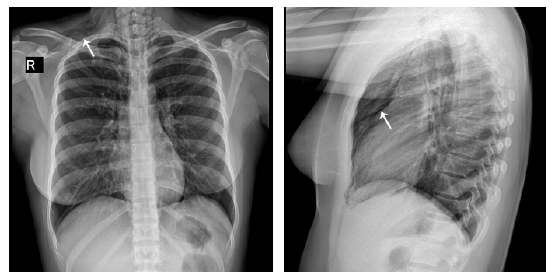 Posteroanterior and lateral chest x-rays. => Subcutaneous emphysema in ...