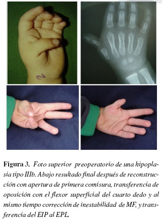 Dr Juanjo López on X: Agenesia cubital de mano. Mano con dos dedos sin  capacidad de pinza, a valorar la pulgarización del dedo radial.   / X