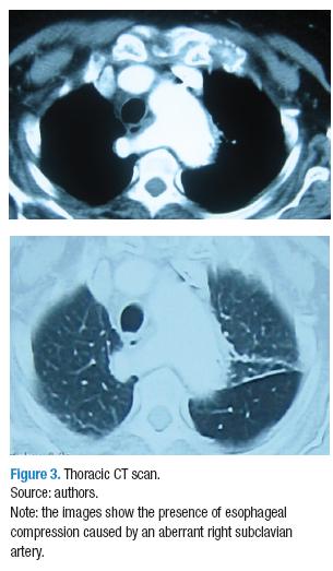 Dysphagia lusoria