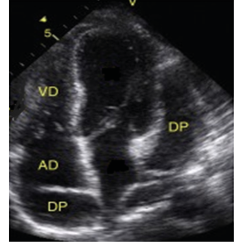 Figure 2. Transthoracic echocardiogram showing mild pericardial ...